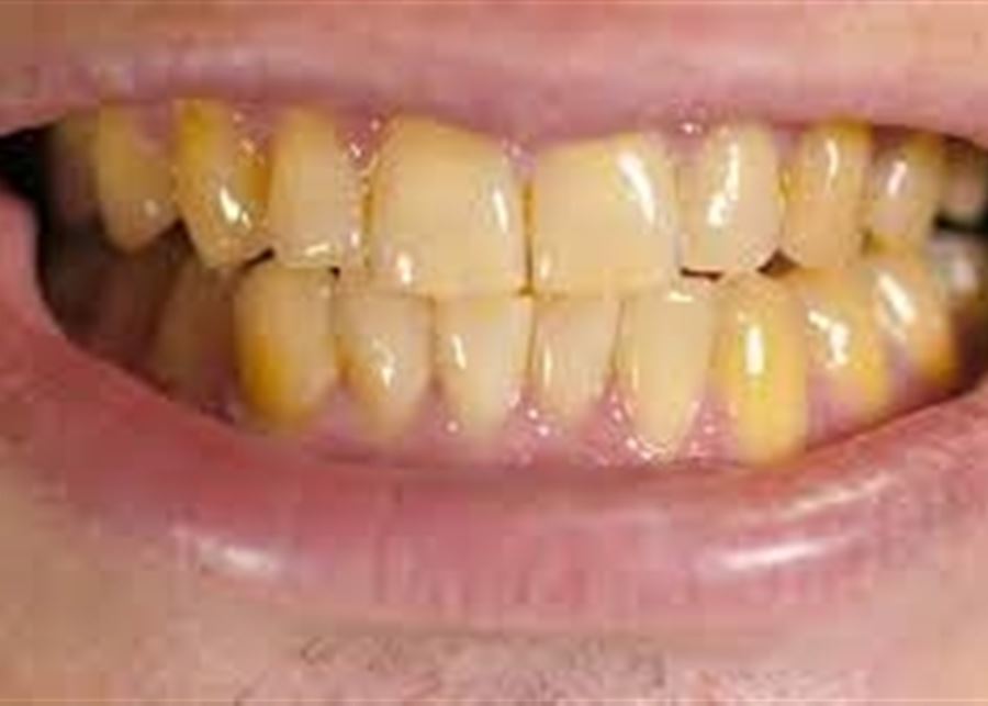  اصفرار الأسنان.. الأسباب وطريقة العلاج